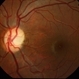 Pale Optic Atrophy Pale Optic Atrophy