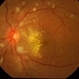 Papilledema With Hypertensive Retinopathy