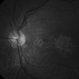 Macular Dystrophy