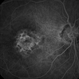 Macular Dystrophy