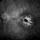 Macular Dystrophy