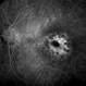 Macular Dystrophy