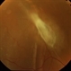 Retinal Detachment Retinal Detachment