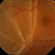 Retinal Detachment Retinal Detachment