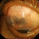 Staphyloma Steroid Induced Glaucoma Staphyloma Steroid Induced Glaucoma