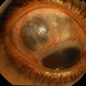 Staphyloma Steroid Induced Glaucoma Staphyloma Steroid Induced Glaucoma