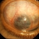 Staphyloma Steroid Induced Glaucoma Staphyloma Steroid Induced Glaucoma