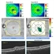 Choroidal Neovascularization with Retinal Angiomatous Proliferation
