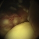 Retinoblastom Group E
