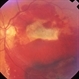 Penetrating ocular injury with posterior impact Penetrating ocular injury with posterior impact