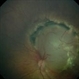 Retinoblastoma Type 2 Regression After Chemo and Laser