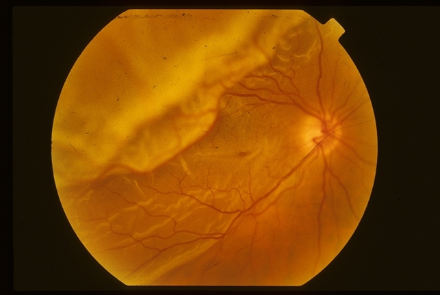 Retinal Detachment with Macular Hole - Retina Image Bank