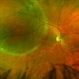Retinal Detachment Right Eye Optomap Retinal Detachment Right Eye Optomap