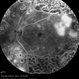 Proliferative Diabetic Retinopathy with PRP