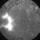 Diabetic Retinopathy Treated With Panretinal Photocoagulation, Neovascularization in the Disc Diabetic Retinopathy Treated With Panretinal Photocoagulation, Neovascularization in the Disc