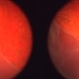 Retinal Detachment, in Stereo Retinal Detachment, in Stereo