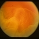 RD with Giant Tear After Trauma RD with Giant Tear After Trauma