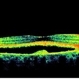 Heredomacular Degeneration Heredomacular Degeneration