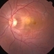 Choroidal Granuloma Secondary to Tuberculosis