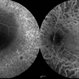 Retinitis Pigmentosa Retinitis Pigmentosa