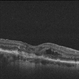 RPE rip macular OCT RPE rip macular OCT