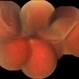 Rhegmatous Retinal Detachment Rhegmatous Retinal Detachment