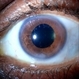 Retained Lens Fragments