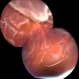 Retinal Detachment With Dislocated IOL Lens