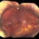 Retinal Detachment With Dislocated IOL Lens