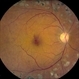 Retinal Macroaneurysm