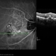 Polypoidal Choroidal Vasculopathy: Case 1 - Image 4 of 7 Polypoidal Choroidal Vasculopathy: Case 1 - Image 4 of 7