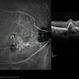 Polypoidal Choroidal Vasculopathy: Case 1 - Image 6of 7 Polypoidal Choroidal Vasculopathy: Case 1 - Image 6of 7