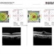 Rubella Retinopathy 1 Rubella Retinopathy 1