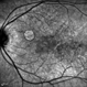 Rubella-Retinopathy 2 Rubella-Retinopathy 2