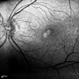 Rubella Retinopathy 3 Rubella Retinopathy 3