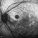 Rubella-Retinopathy 4 Rubella-Retinopathy 4
