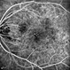 Rubella Retinopathy 5 Rubella Retinopathy 5