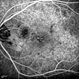 Rubella Retinopathy 6 Rubella Retinopathy 6