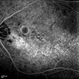 Rubella Retinopathy 7 Rubella Retinopathy 7