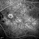Rubella Retinopathy 8 Rubella Retinopathy 8