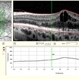 Rubella Retinopathy 9 Rubella Retinopathy 9