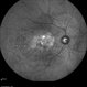Stargardt's Disease Stargardt's Disease