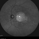 Stargardts Disease Stargardts Disease