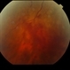 Proliferative Diabetic Retinopathy with Vitreous Hemorrhage - color fundus photo Proliferative Diabetic Retinopathy with Vitreous Hemorrhage - color fundus photo
