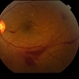 Proliferative Diabetic Retinopathy with Vitreous Hemorrhage - color fundus photo Proliferative Diabetic Retinopathy with Vitreous Hemorrhage - color fundus photo
