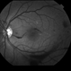 Proliferative Diabetic Retinopathy with Vitreous Hemorrhage - Red Free Proliferative Diabetic Retinopathy with Vitreous Hemorrhage - Red Free