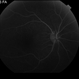 Proliferative Diabetic Retinopathy with Vitreous Hemorrhage - FA early Proliferative Diabetic Retinopathy with Vitreous Hemorrhage - FA early