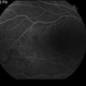 Proliferative Diabetic Retinopathy with Vitreous Hemorrhage - FA mid Proliferative Diabetic Retinopathy with Vitreous Hemorrhage - FA mid