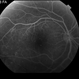Proliferative Diabetic Retinopathy with Vitreous Hemorrhage - FA mid Proliferative Diabetic Retinopathy with Vitreous Hemorrhage - FA mid