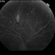 Proliferative Diabetic Retinopathy with Vitreous Hemorrhage - FA mid Proliferative Diabetic Retinopathy with Vitreous Hemorrhage - FA mid